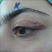 Hinchazón del párpado superior de un ojo: causas y tratamiento en adultos.