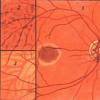 Fundus of the eye and its pathologies