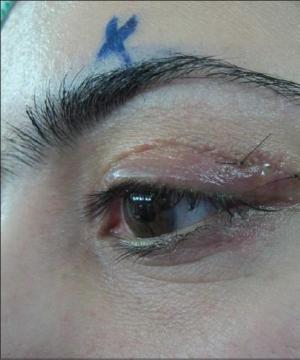 Swelling of the upper eyelid of one eye: causes and treatment in adults