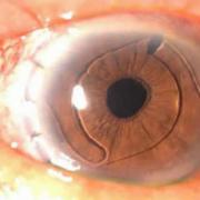 Tentang masalah koreksi tambahan kesalahan refraksi setelah implantasi lensa intraokular “kelas premium”.