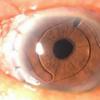 فيما يتعلق بمسألة التصحيح الإضافي للأخطاء الانكسارية بعد زراعة العدسات داخل العين من 