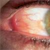 Pterygium - what is it?